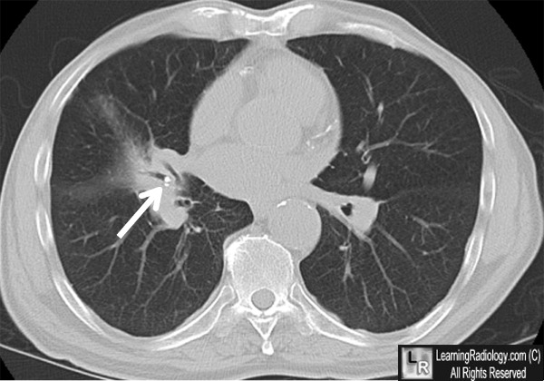 Broncholithiasis